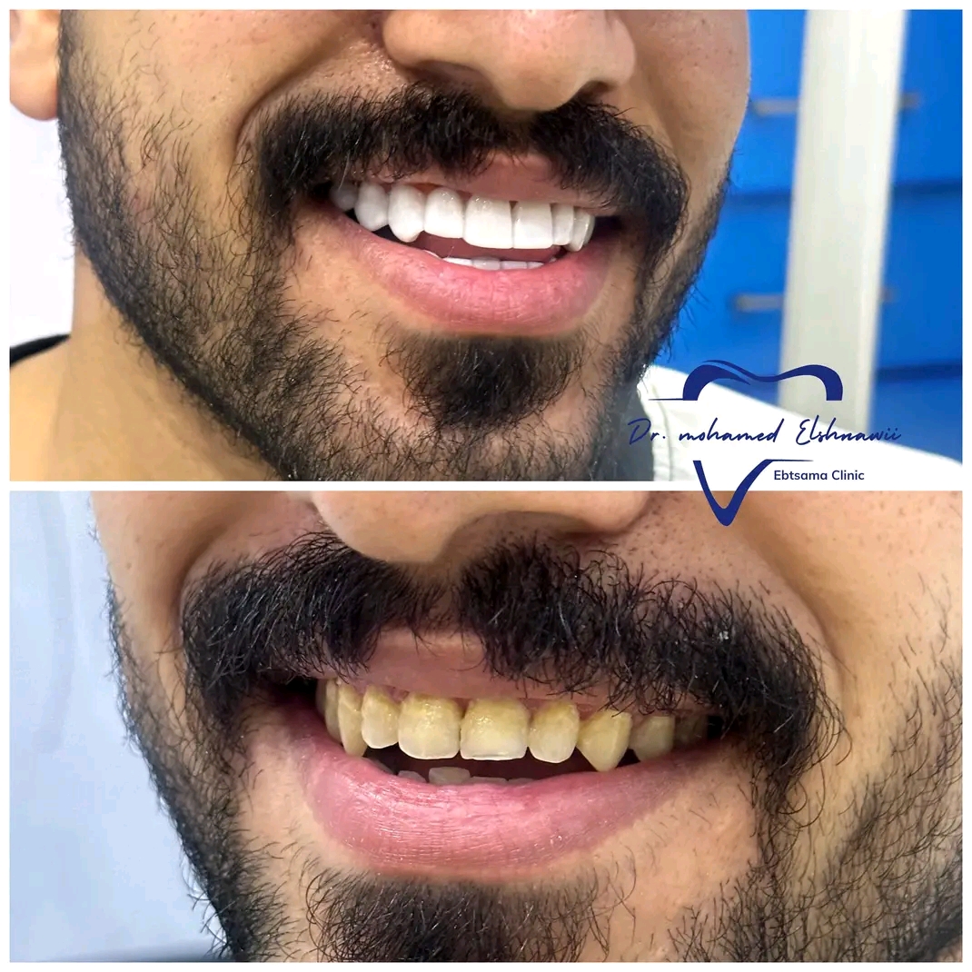 تبييض الأسنان د. الشناوي